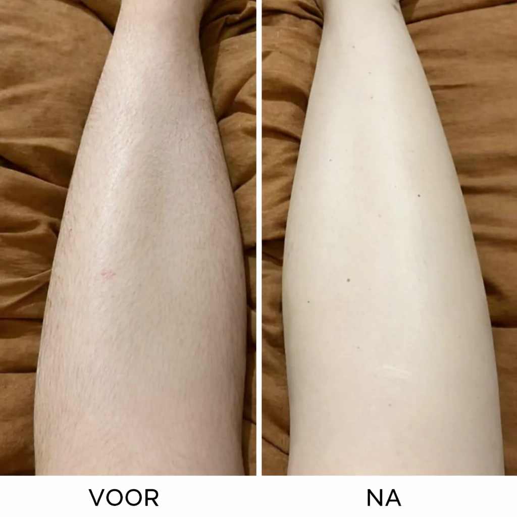 Silkéra™ Precision Hair Remover