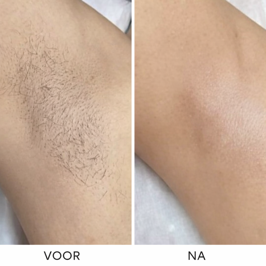Silkéra™ Precision Hair Remover